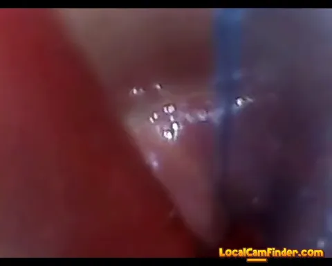 test tube cock endoscope POV urethral insertion ba Part 24