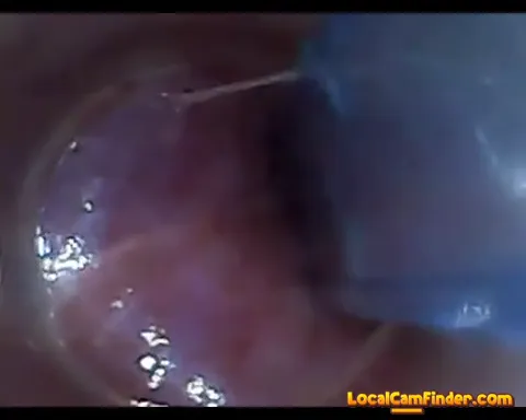 test tube cock endoscope POV urethral insertion ba Part 7