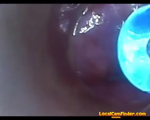 test tube cock endoscope POV urethral insertion ba Part 8