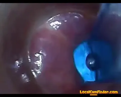 test tube cock endoscope POV urethral insertion ba Part 9
